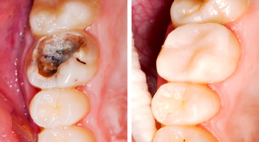 sâu răng, đau răng, cách trị sâu răng, 3 cách tự nhiên đánh bật các lỗ sâu răng, 